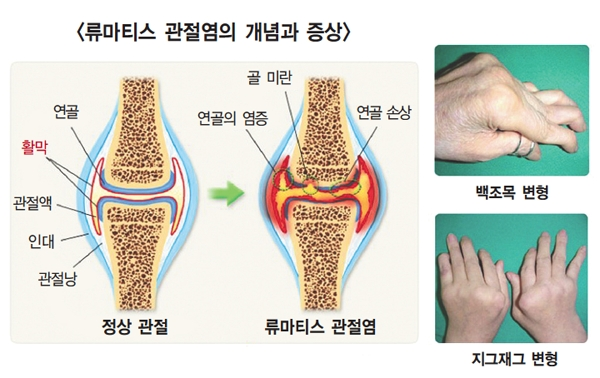 쎄레브렉스캡슐100MG는 어떤 증상에 효과적인가?