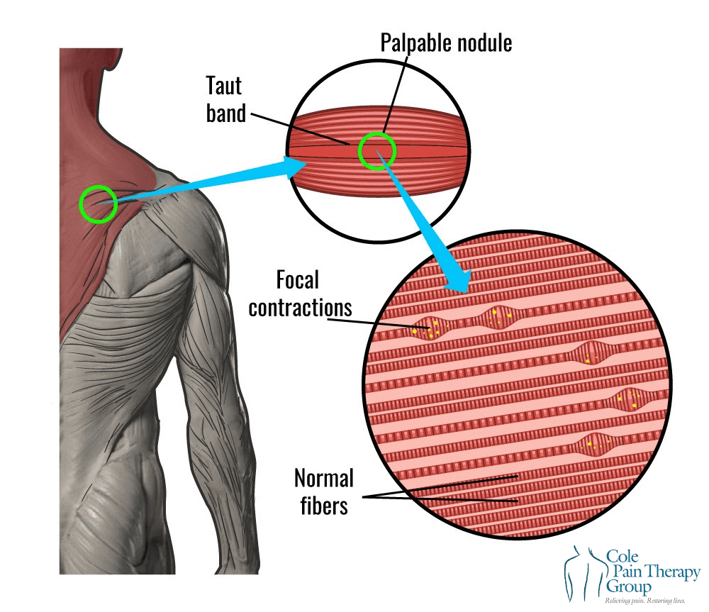근육 긴장에 따른 근육내 경결 형성구조