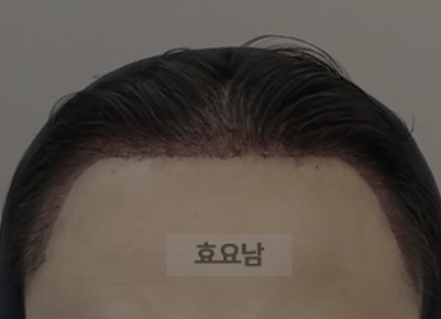 M자 모발이식 수술-후