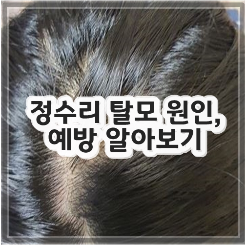 정수리 탈모 원인, 예방 알아보기