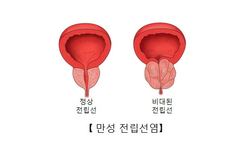 전립선 질환