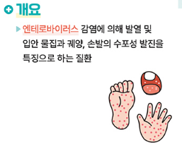 수족구병 예방과 치료 여름철 아이 건강 관리
