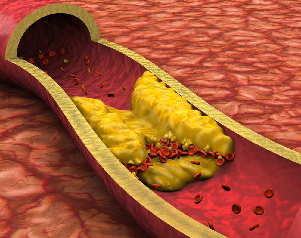 고지혈증으로 인한 동먁경화