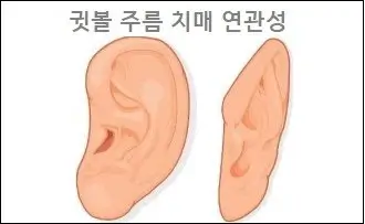 귓볼 주름 치매 연관성