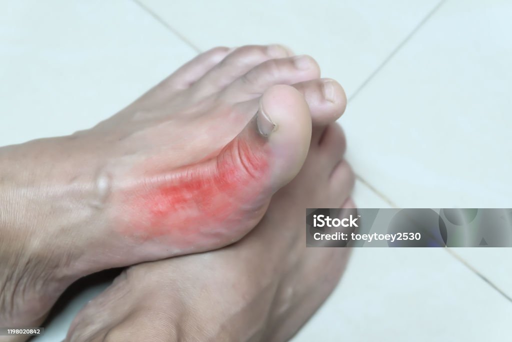 한포진 관련 사진