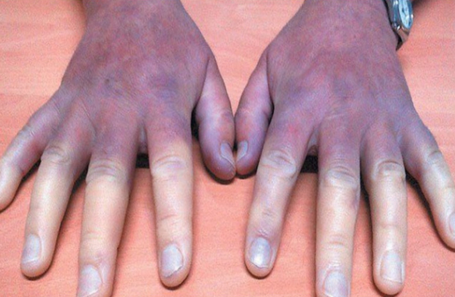 동상에 걸려 양쪽 손등이 검붉게 피부가 변질이 되어 있는 것을 찍은 사진