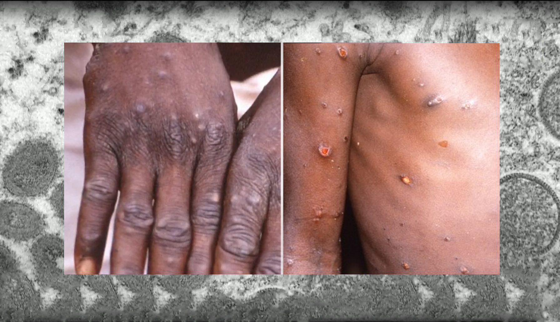 원숭이두창바이러스-손과-몸에-물집-성관계