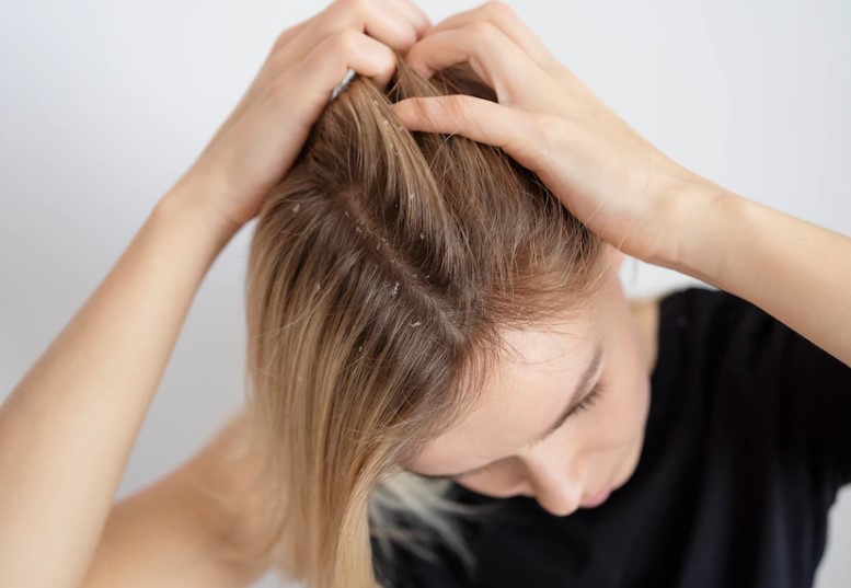 탈모원인비듬
탈모근본대책
탈모비듬원인
비듬탈모