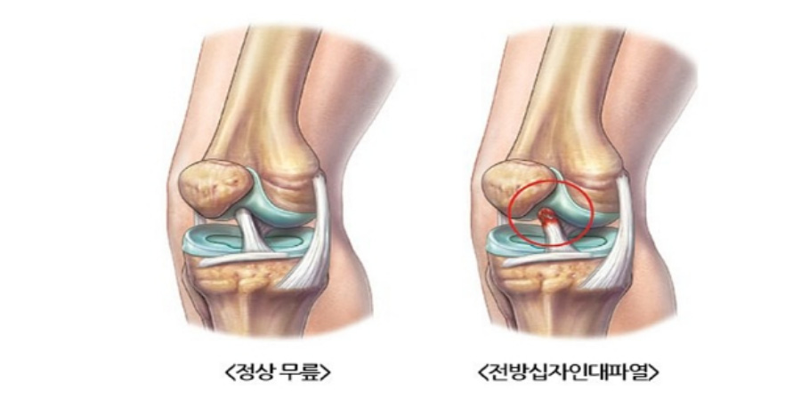 정상적인 무릎의 해부학적인 그림과 전방십자인대가 파열되었을 때의 해부학적인 그림을 비교해 놓은 이미지 사진