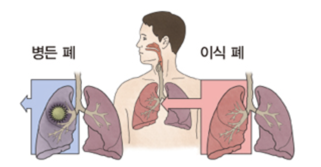 특발성폐섬유화증