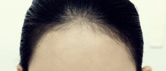 헤어라인 문신 후