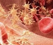 혈색소 수치 낮으면