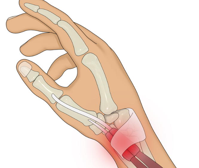 건초염 진단 시 필요한 검사