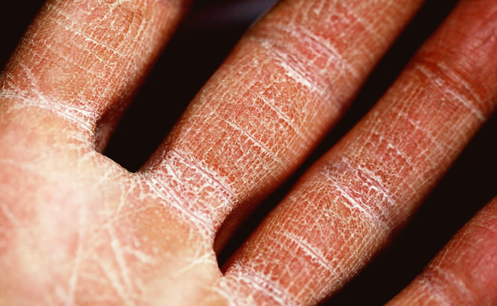 가려움이 밤에 심해지는 이유와 수면을 지키는 현실 전략