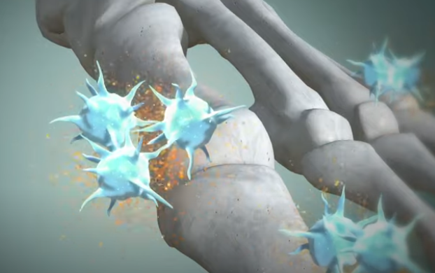 통풍 증상과 치료방법