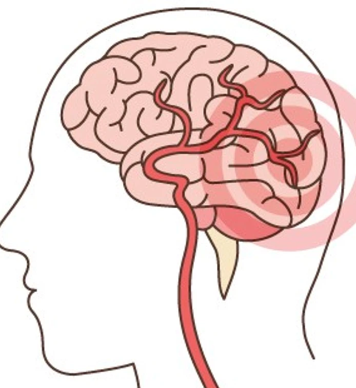 뇌졸중 전조증상