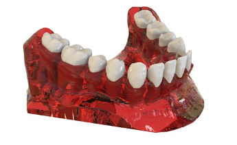 임플란트 시술의 장단점