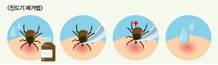 살인진드기 제거방법