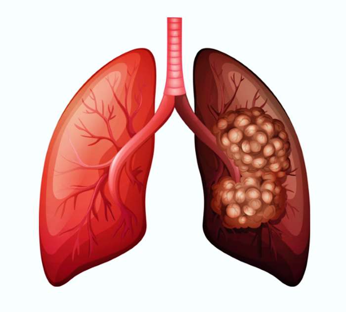 반드시 알아야 할 몸이 보내는 신호 폐암 초기 증상 8가지