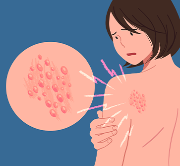 대상포진 일러스트 이미지