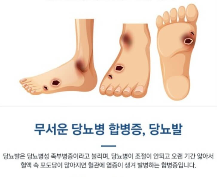 당뇨발