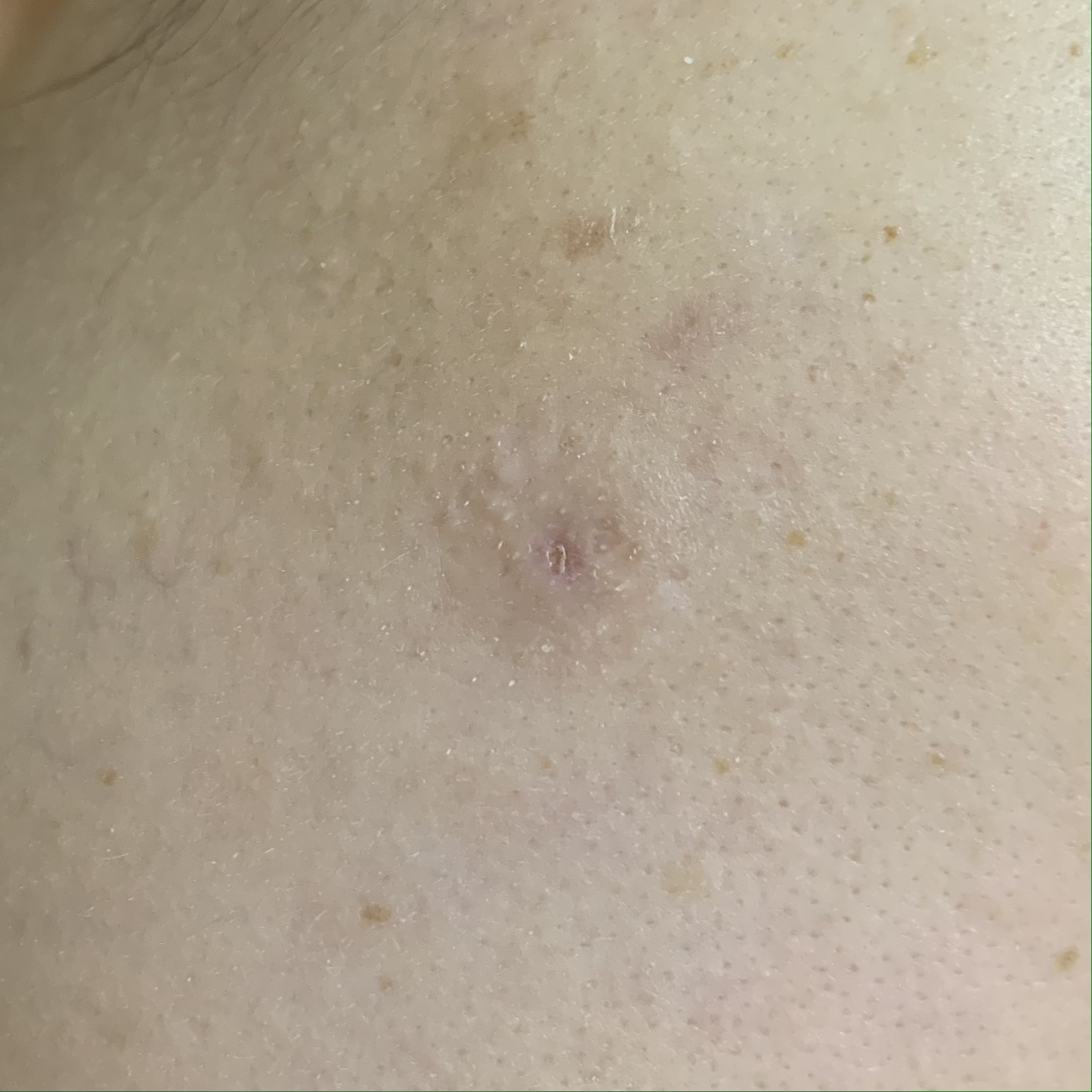 피지낭종 수술10일차