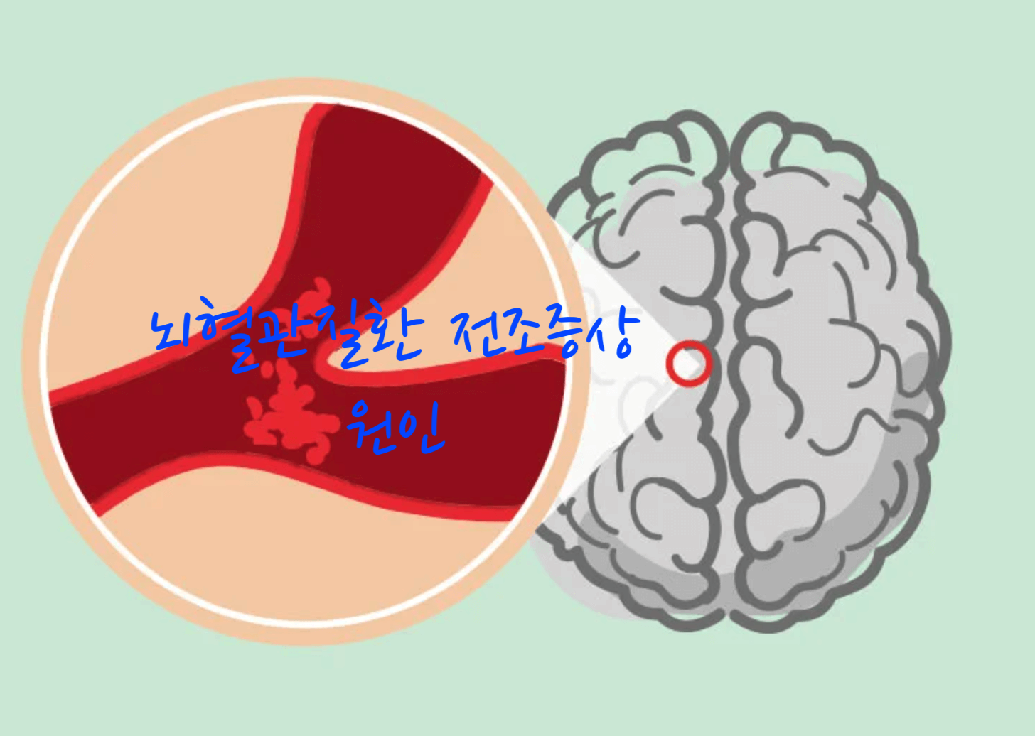 뇌혈관질환