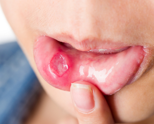 구내염 원인, 치료법, 좋은 음식 섬네일