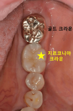 임플란트 보철재 비교 총정리 (Gold PFM Zirconia )