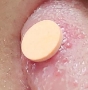구내염 패치 아프타치