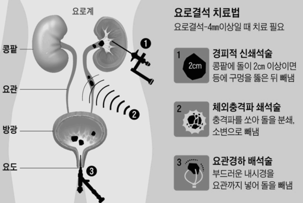 요로결석 치료법