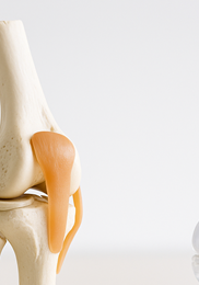 퇴행성 관절염 완치하는 최고의 비법