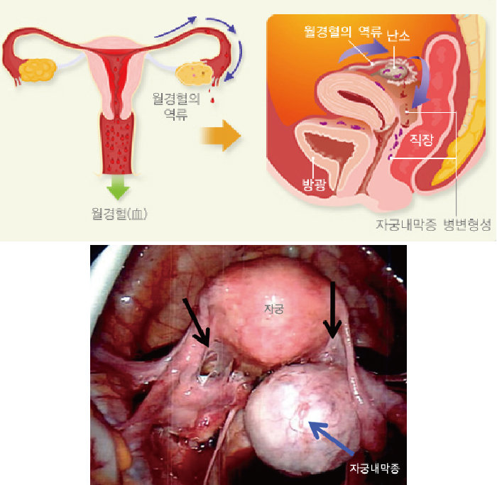 임신 방해하는 자궁내막증