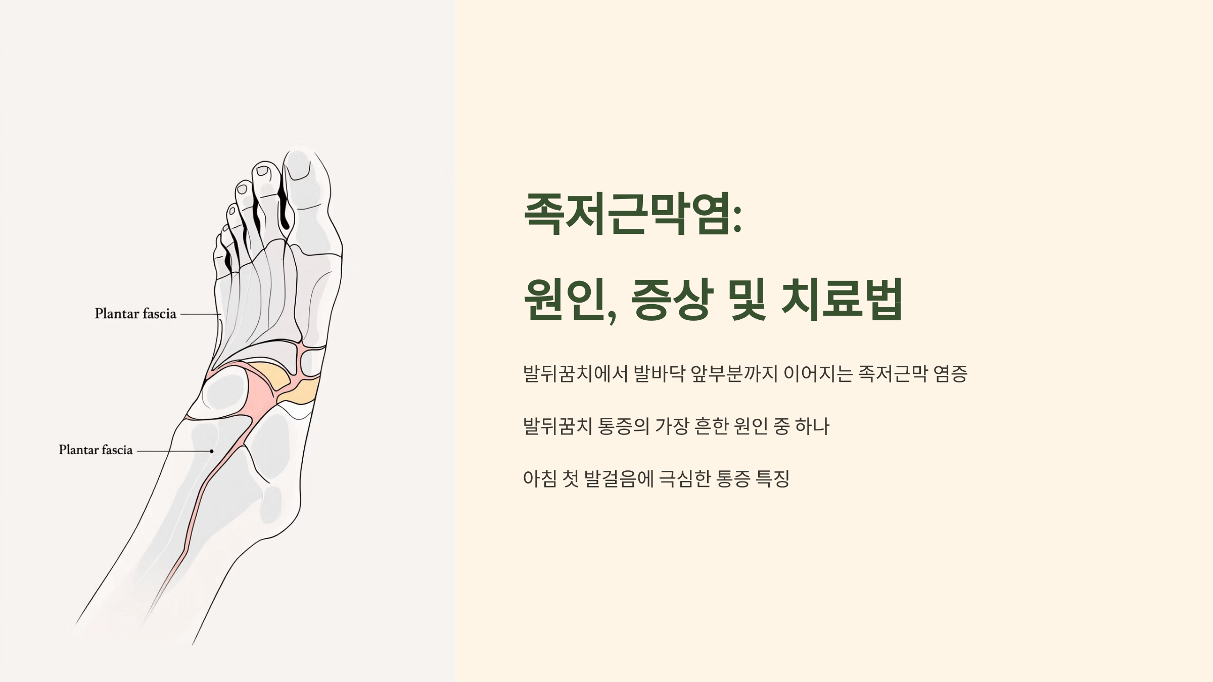 족저근막염과 관련된 사진입니다.