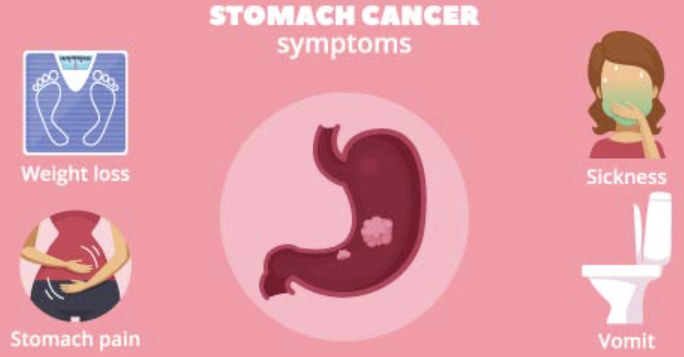 위암 초기증상 2
