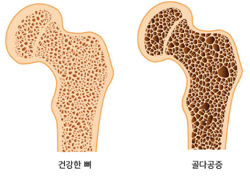 골다공증 피할 수 있는 질병인가: 예방 법