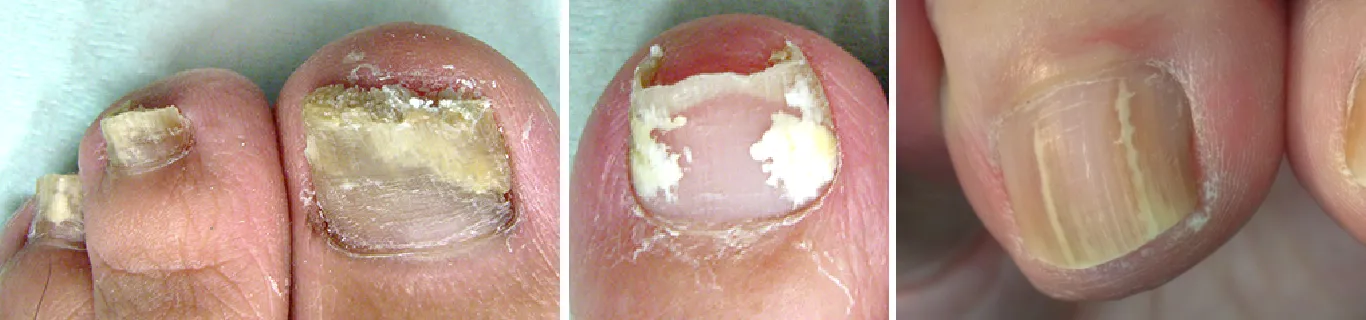 발톱-무좀-이미지