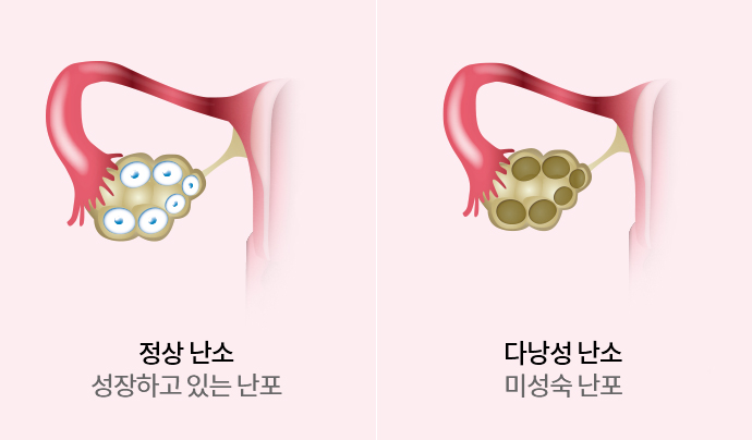 다낭성 난소 증후군(PCOS)의 원인과 치료법