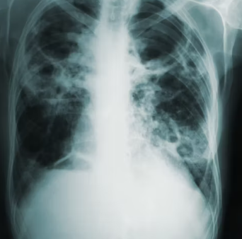 천식 치료법 진단 기준 합병증