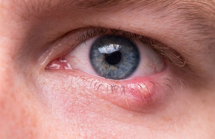 다래끼 전염 원인 및 다래끼 초기증상 7가지 완벽 정리