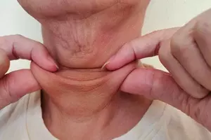 목주름 시술