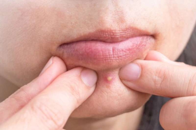 여드름 부위별 원인