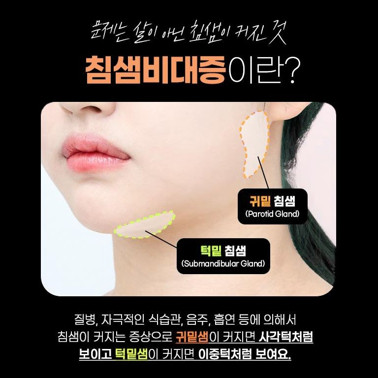 사각턱 보톡스