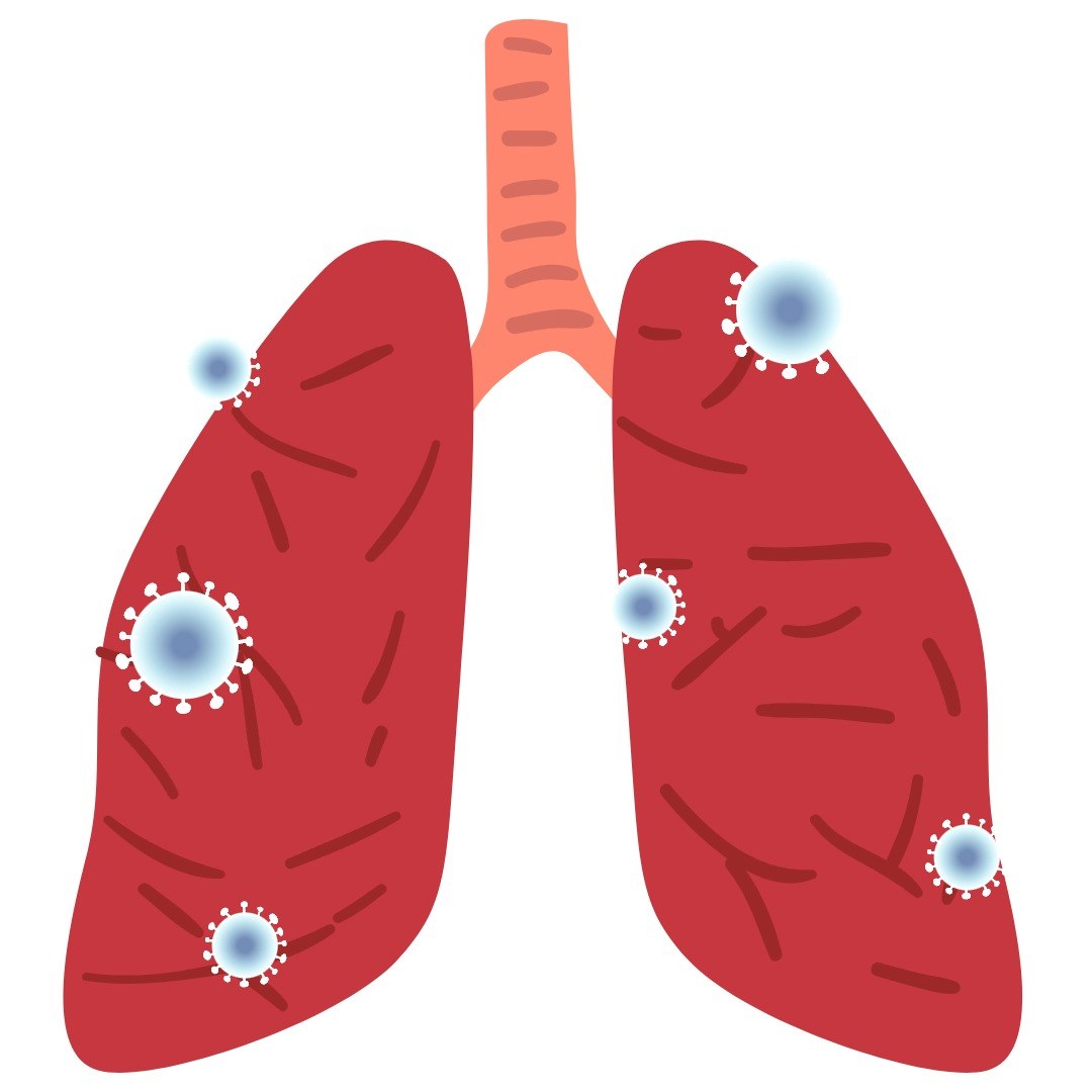 마이코플라스마-폐렴-1