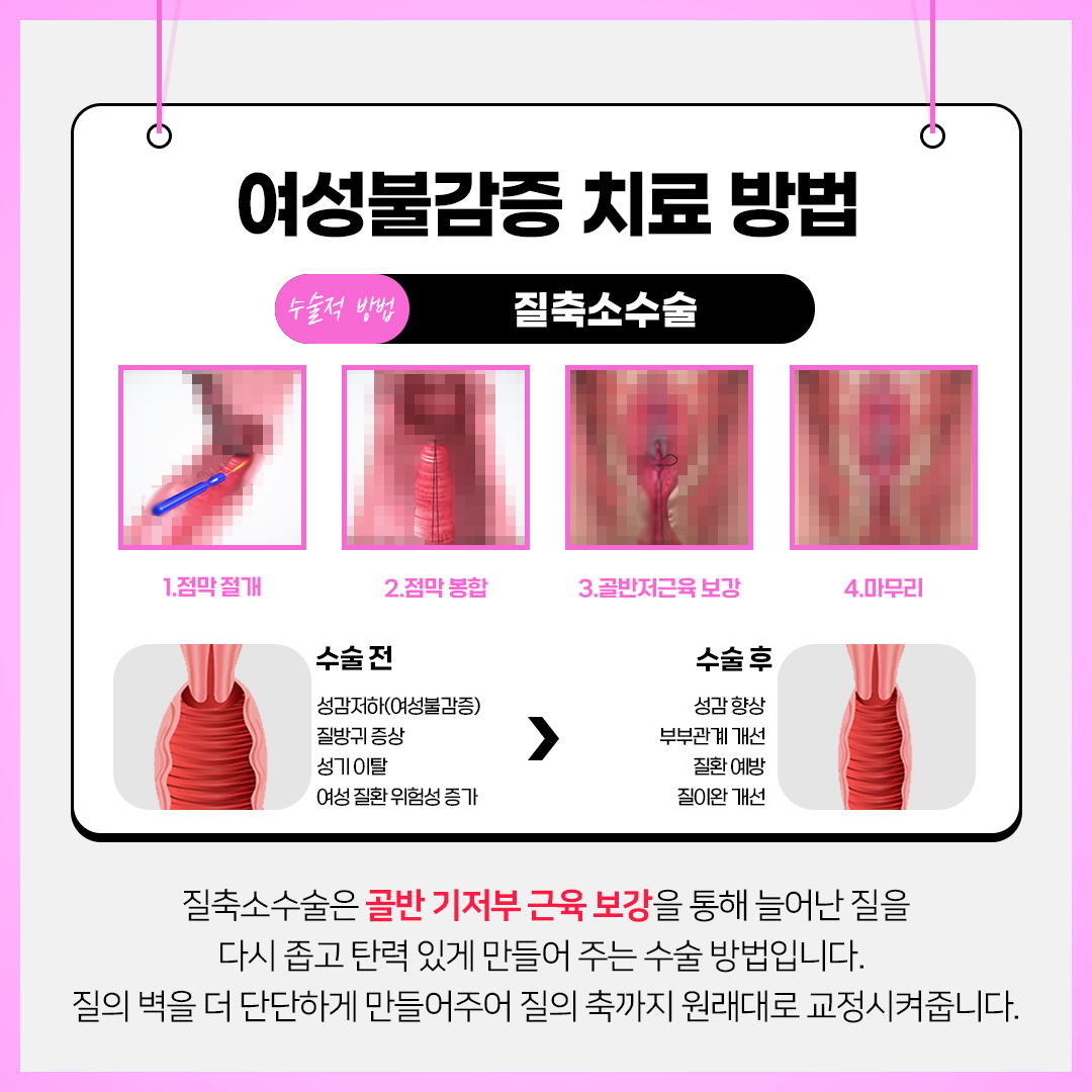 여성불감증 치료 방법 : 질축소수술