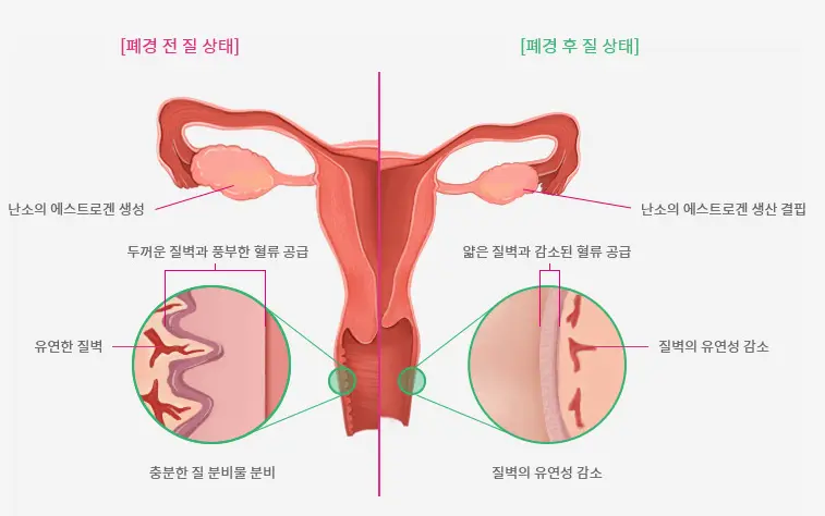 폐경후질건조증-비교예시-이미지