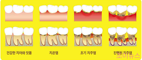 잇몸 염증 치료방법