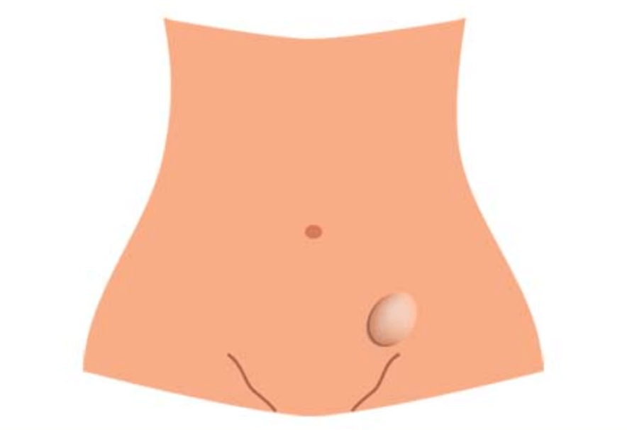 윈쪽 아랫배 혹