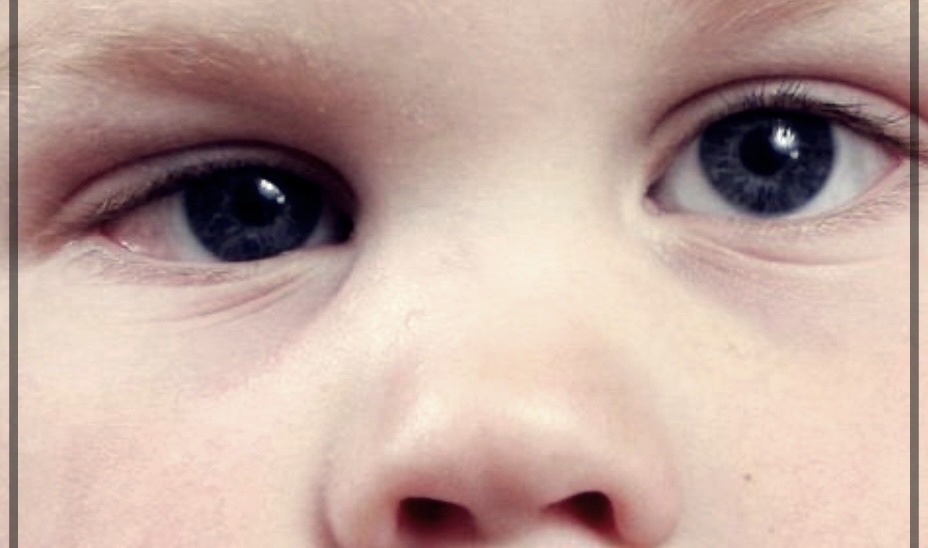 눈 사시 고치는 법.