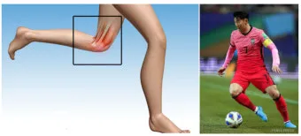 거위발 건염 원인과 증상 무릎 안쪽 통증 치료법 정리_10